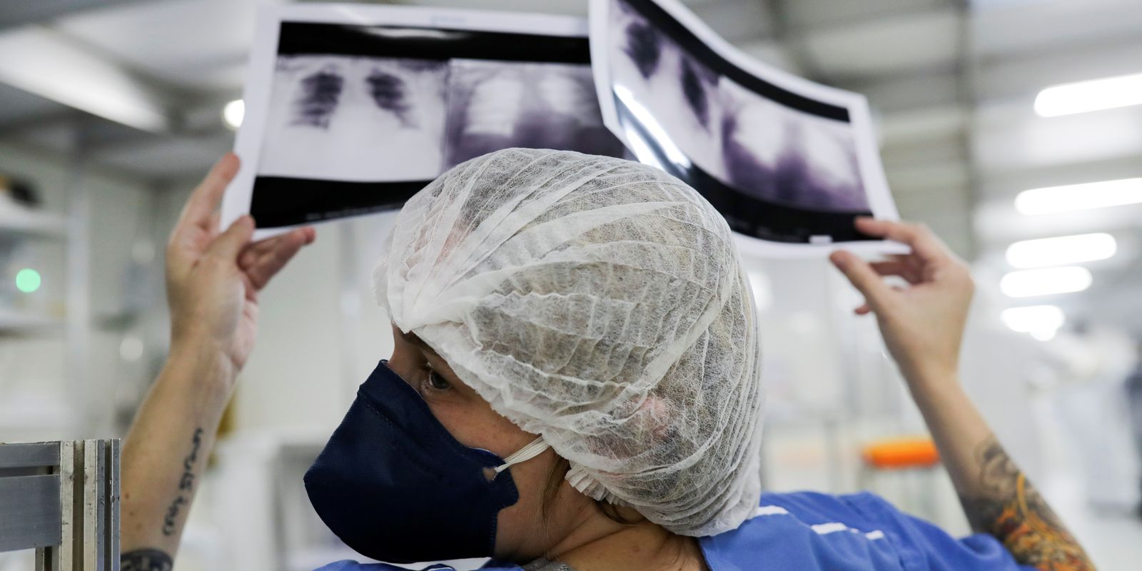 Diagnóstico tardio dá poucas chances de cura para o câncer de pulmão 