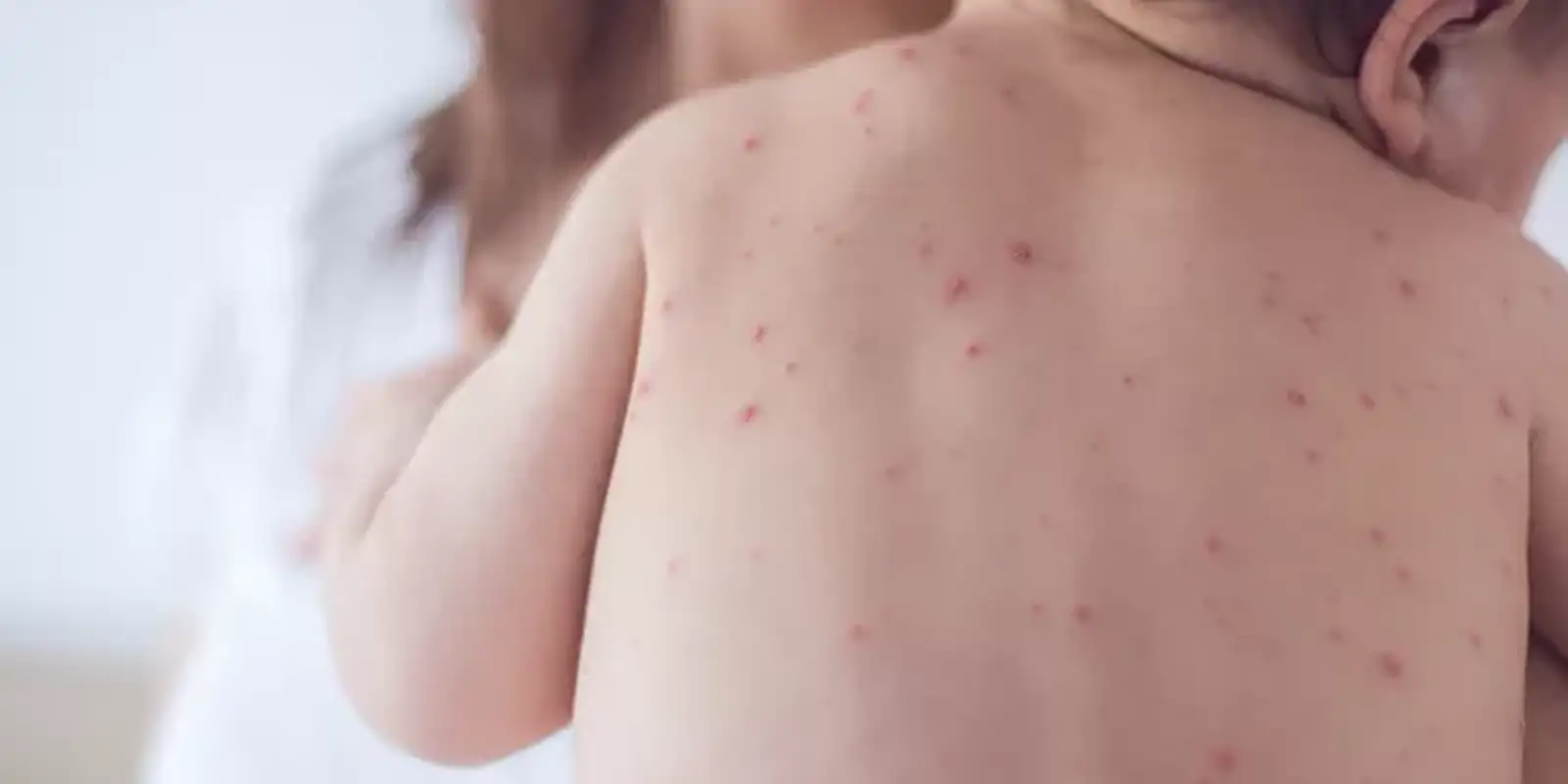 Estado de São Paulo reforça necessidade de vacinação contra o sarampo 